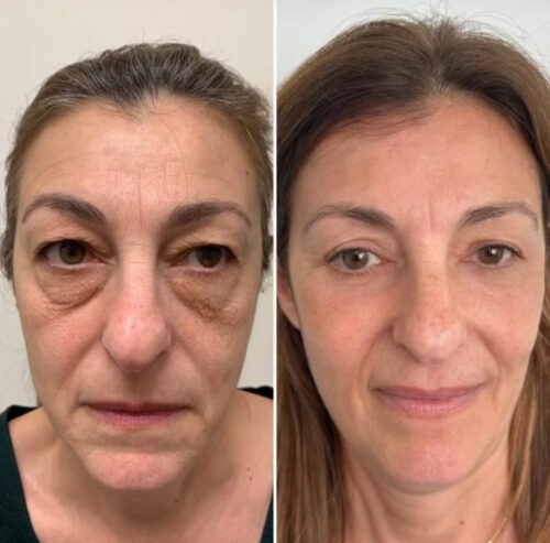 LUNÉRO PRO photo review