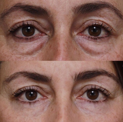 LUNÉRO PRO photo review