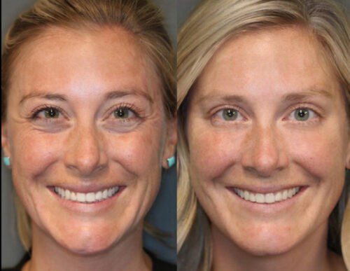 LUNÉRO PRO photo review